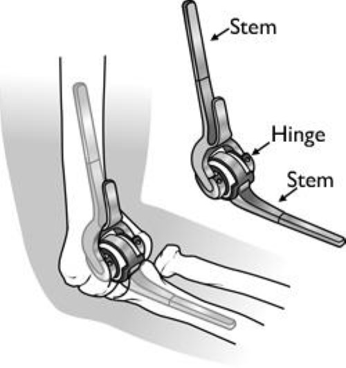 Total Elbow Replacement Jewett Orthopaedic Clinic Dr Brian BarnardJewett Orthopaedic Clinic