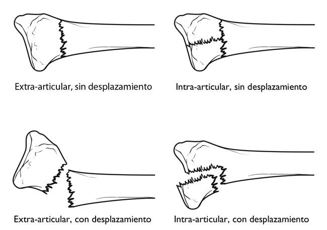 Fracturas Distales Del Radio Muñeca Quebrada Distal Radius Fractures Broken Wrist 