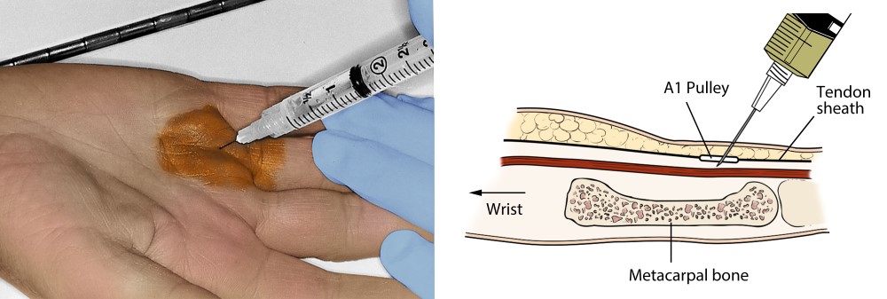 Steroid injection into A1 pulley