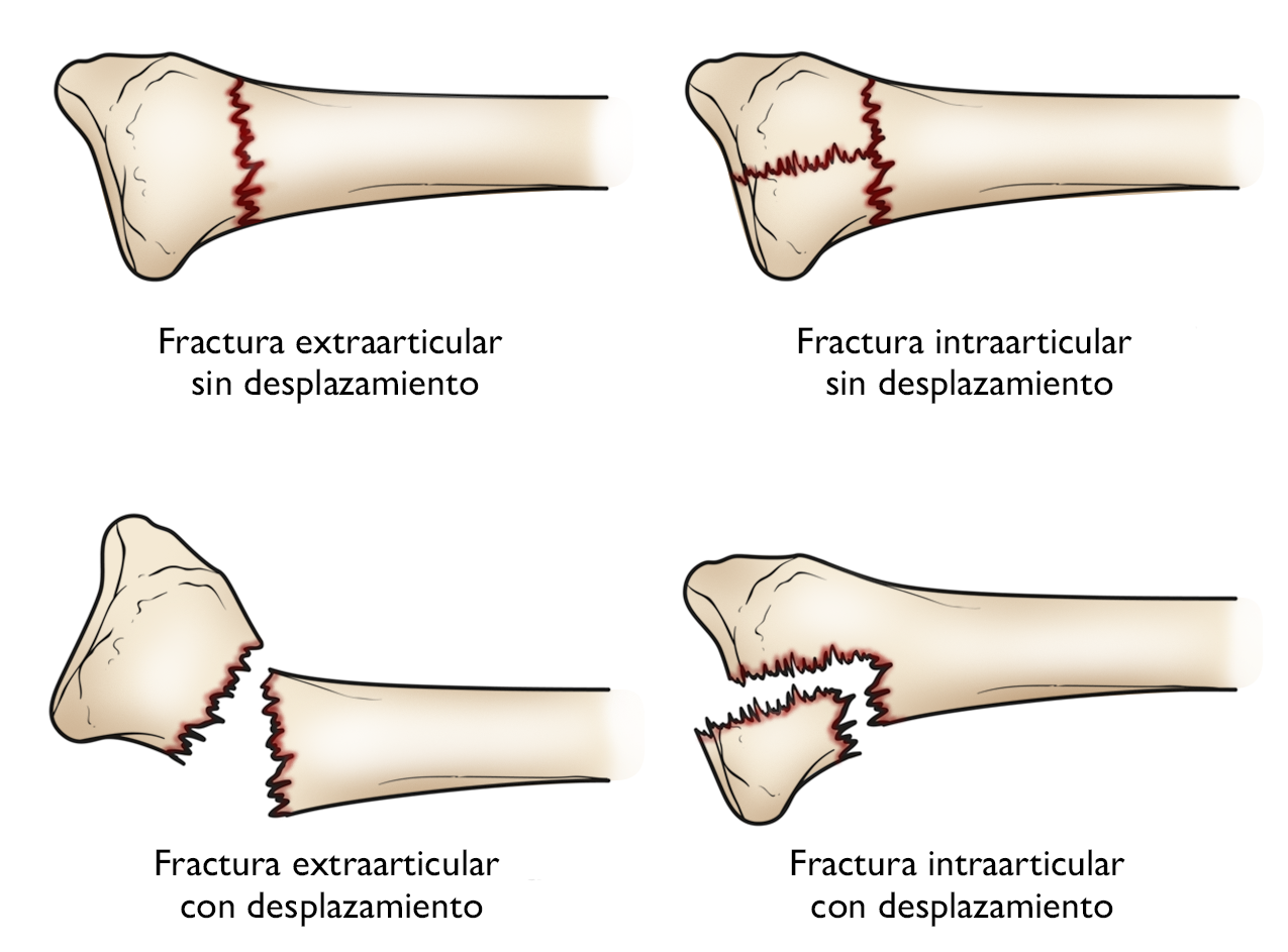 Fracturas Distales Del Radio Mu Eca Quebrada Distal Radius Fractures