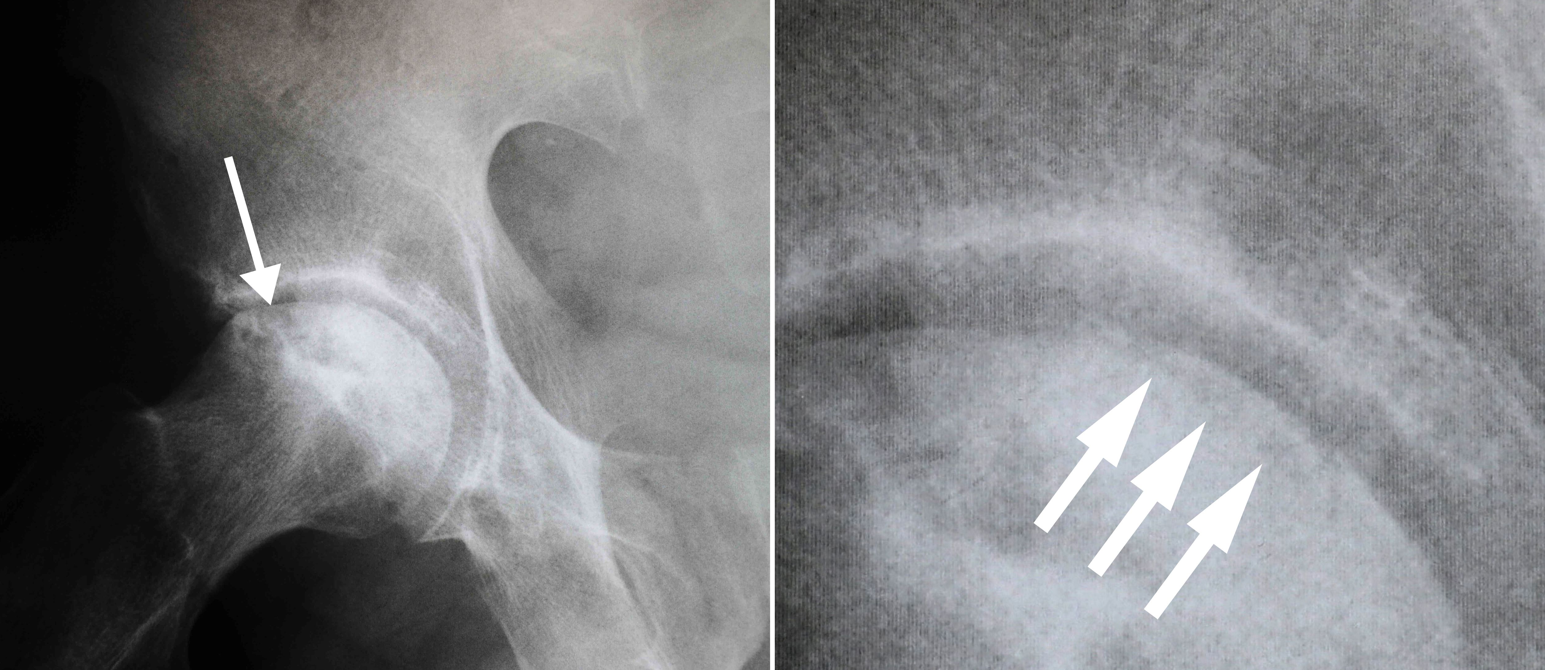 Osteonecrosis of the hip