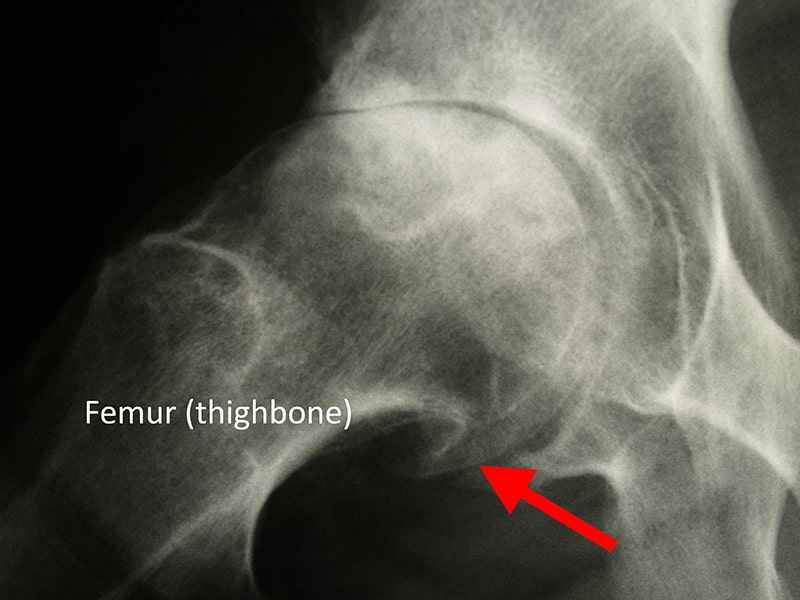 bone spur