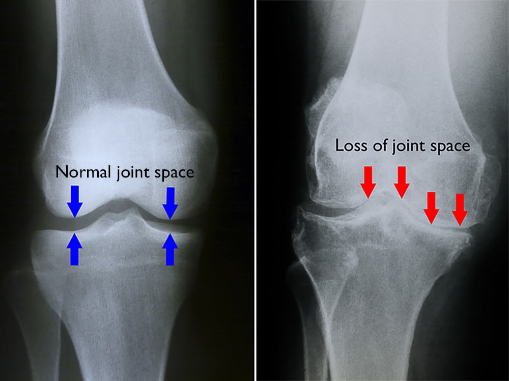 normal and arthritic knee