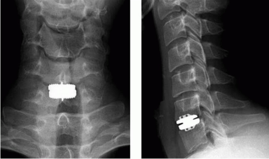 Front and Side X-Rays of Cervical Disk Replacement