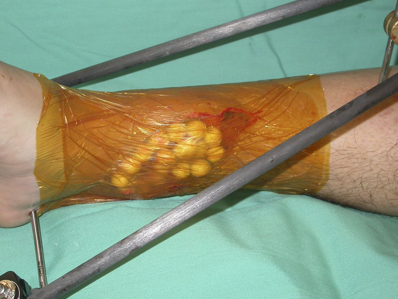 Antibiotic beads