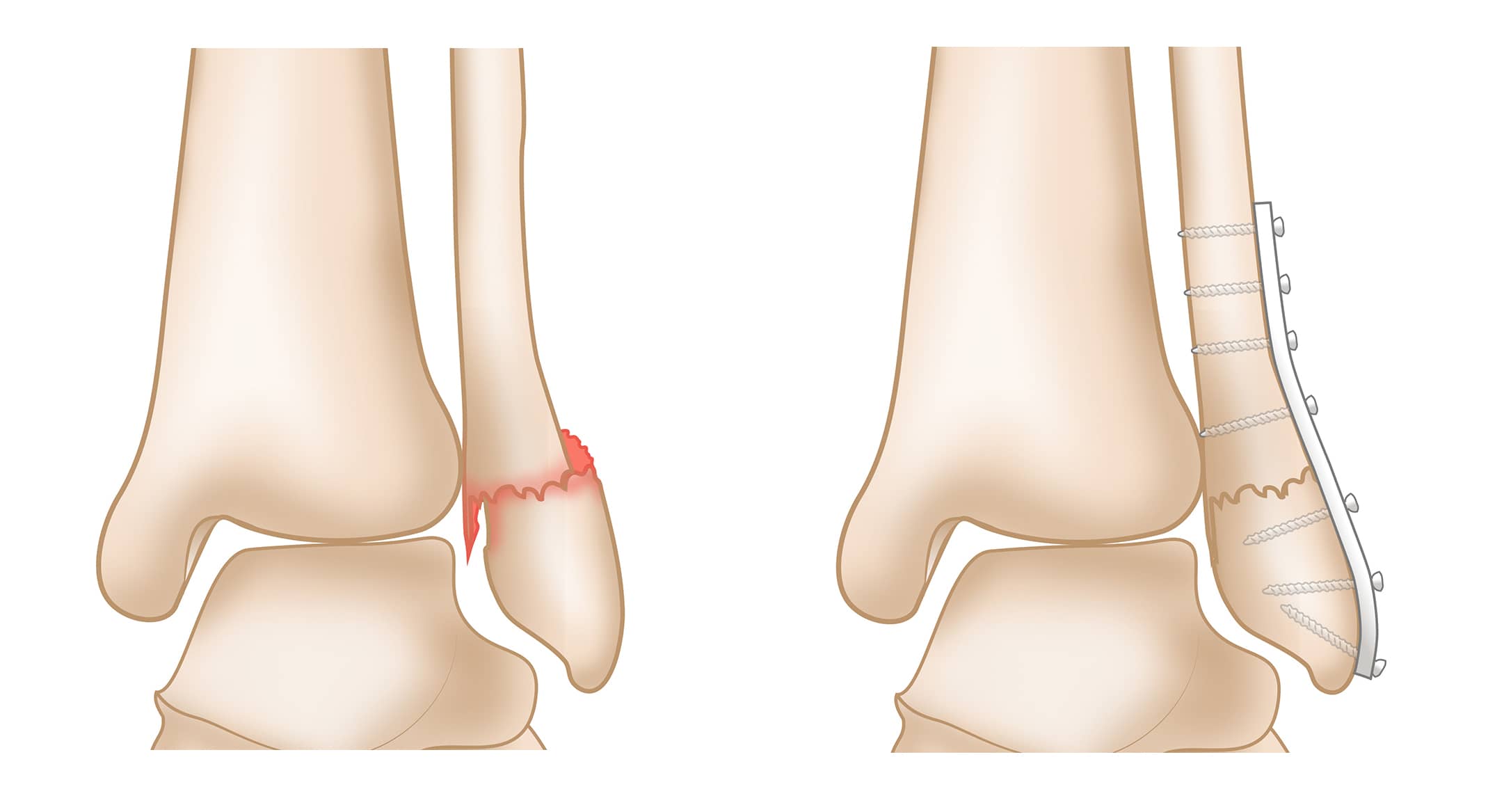 Displaced Lateral Malleolus Fracture and Repair
