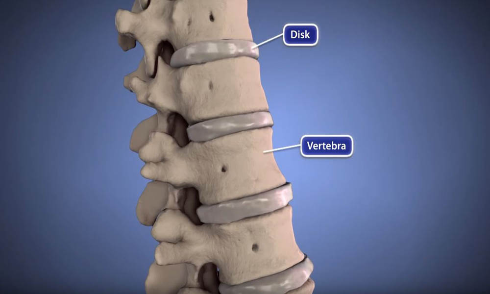 Cervical Spondylotic Myelopathy (CSM) - Spinal Cord Compression - OrthoInfo  - AAOS