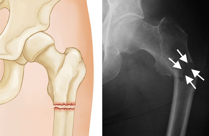 subtrochanteric fracture