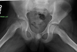 X-ray of stable SCFE