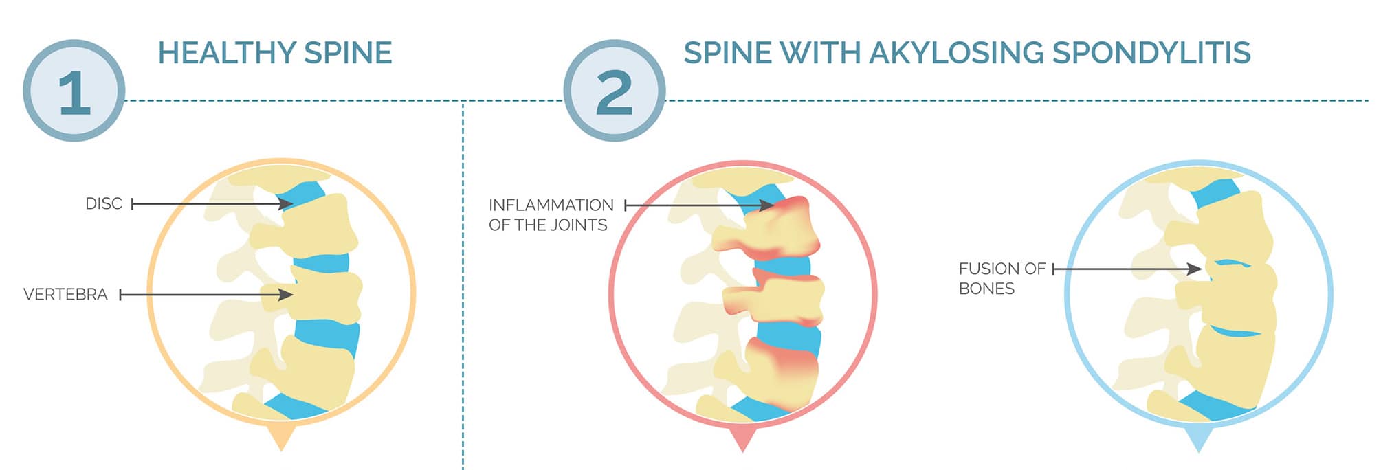 Illustration Showing Progression of Ankylosing Spondylitis
