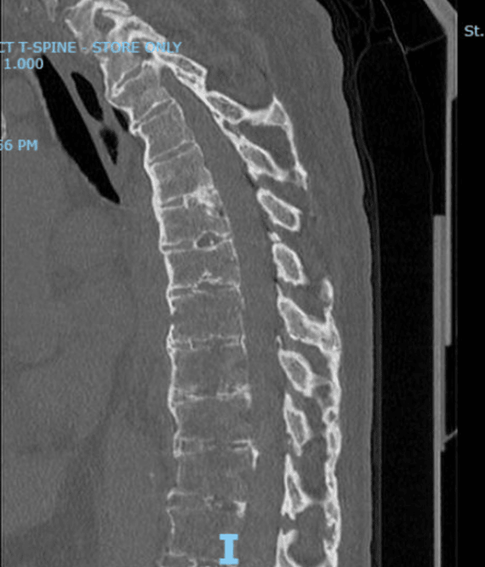 CT Scan Showing Ankylosing Spondylitis