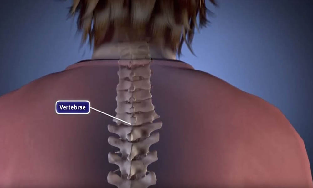 Degenerative Cervical Spine with Posterior Fusion