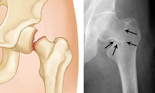 femoral neck fracture