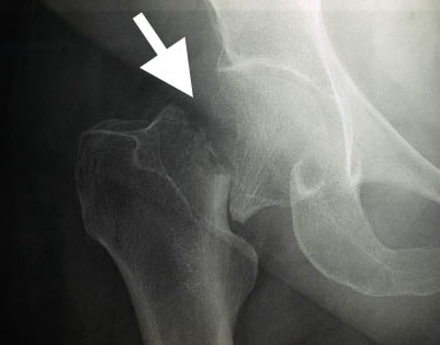 hip fracture