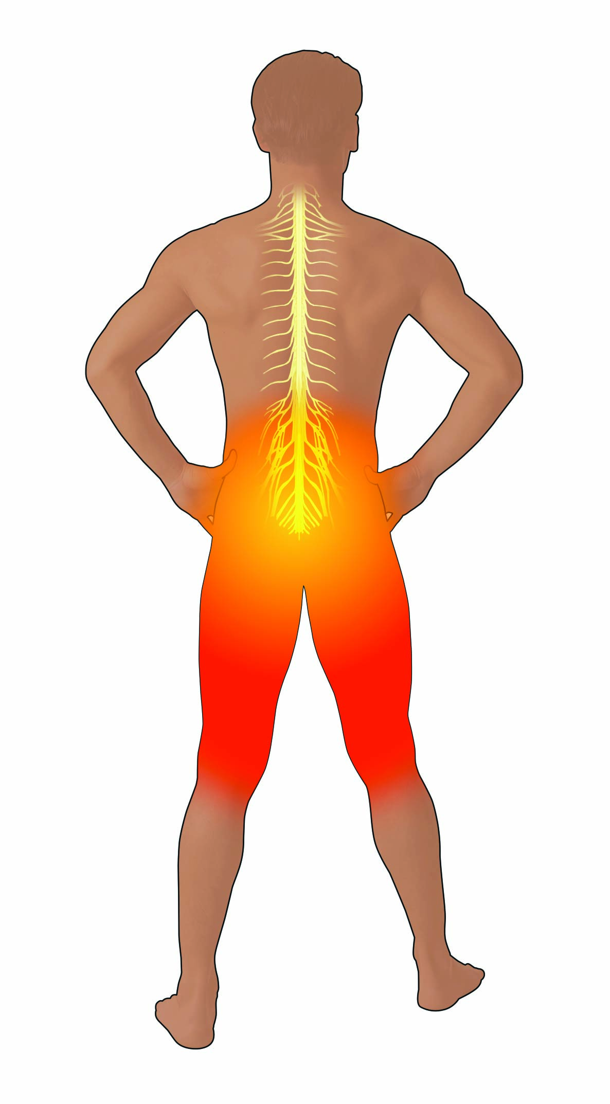 Location of pain from spondylolysis and spondylolisthesis