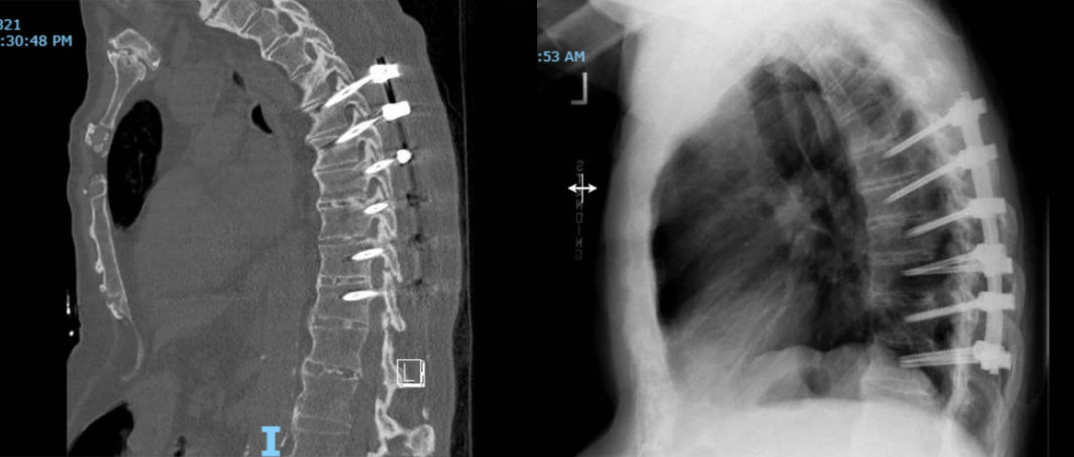 CT Scan and X-Ray After Fusion Surgery for Ankylosing Spondylitis