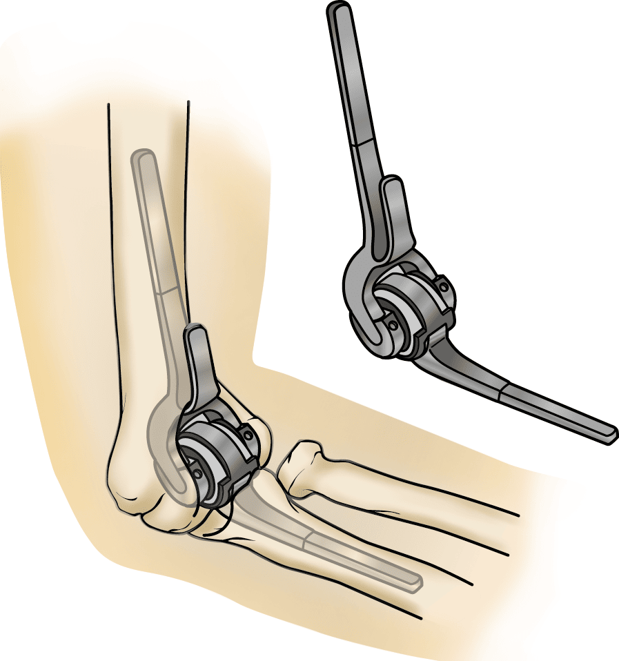 Total elbow replacement components