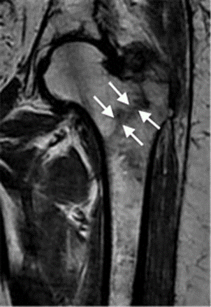 hip fracture
