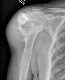 X-ray of Chondrosarcoma
