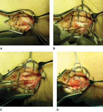 Surgical Photos Showing Side-by-Side Repair for Medial Epicondylitis