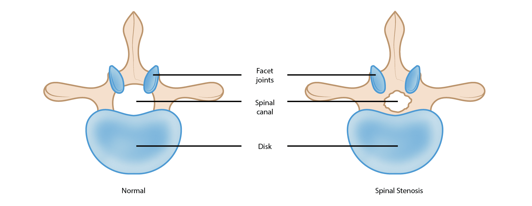 Lumbale Spinalkanalstenose