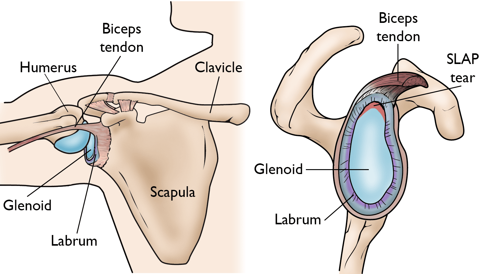 shoulder labrum and SLAP tear