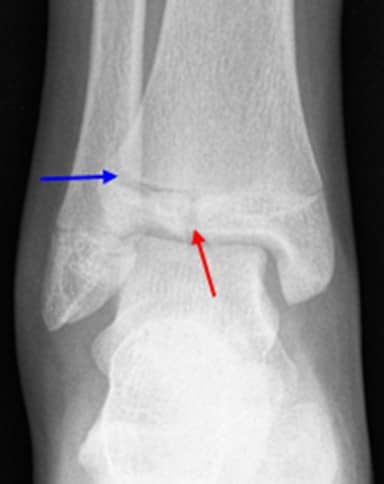 Tillaux fracture