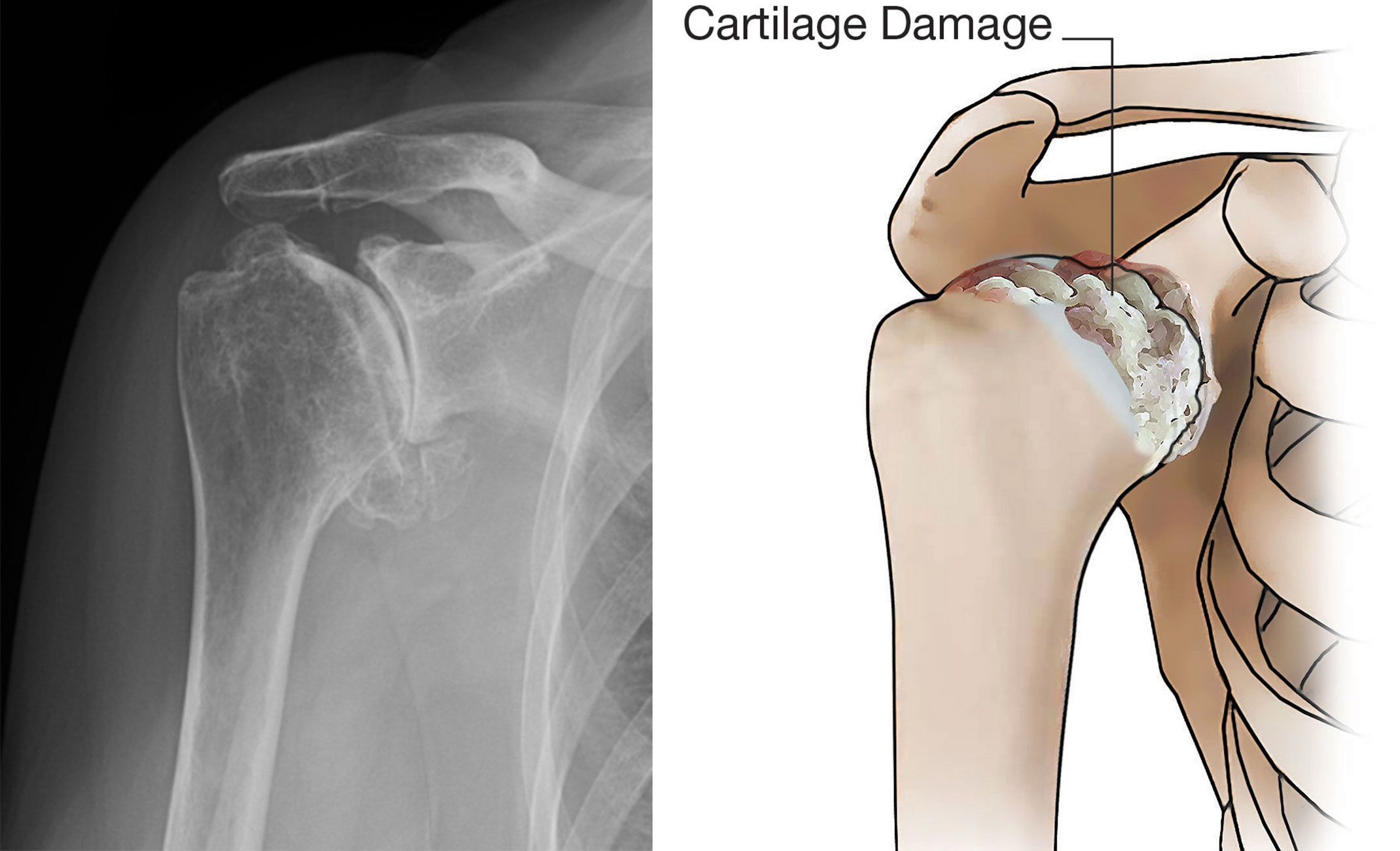 X-ray and illustration showing osteoarthritis of the shoulder