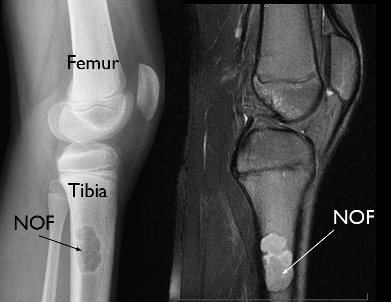 x-ray and mri of nonossifying fibroma