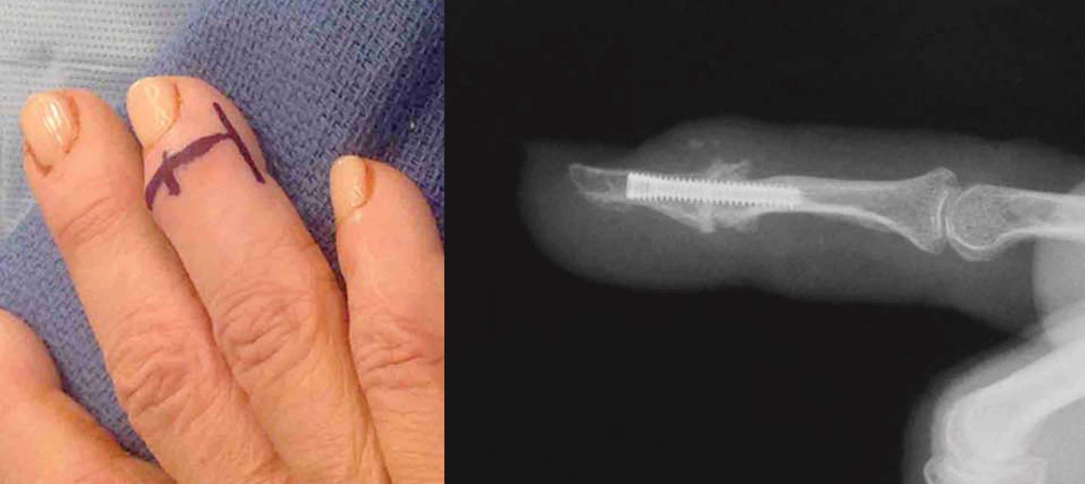 Photos Showing Finger Marked for Fusion and Post-Fusion X-Ray