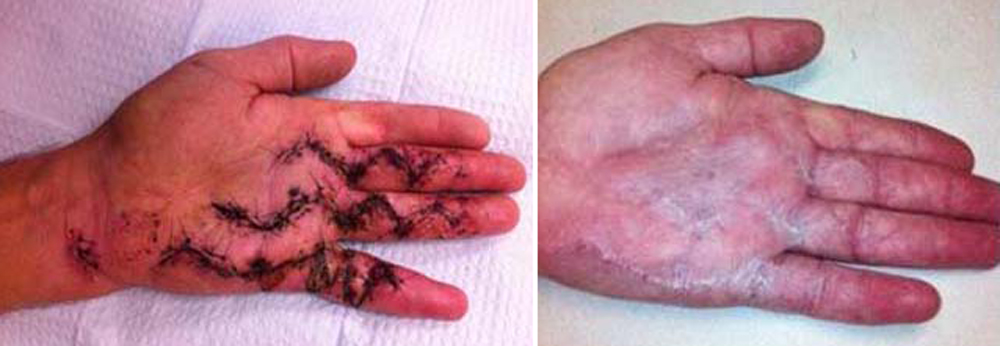 Subtotal palmar fasciectomy