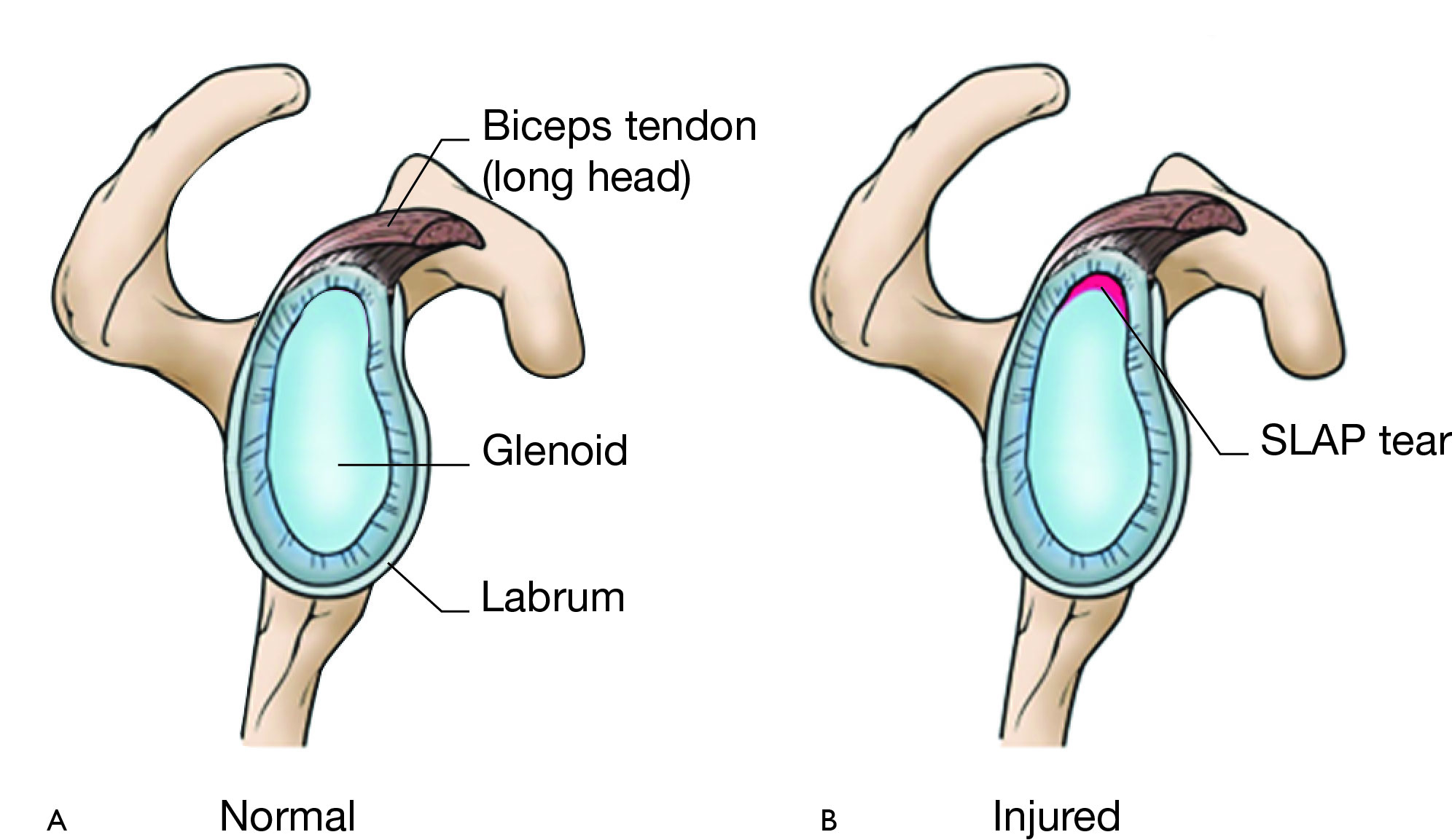 Normal Shoulder Anatomy and SLAP tear