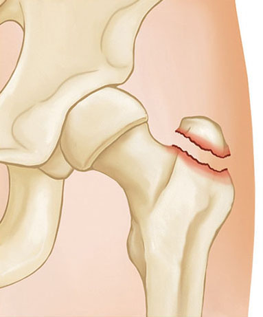 fracture of the greater trochanter