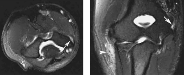 MRI Showing Elbow With Medial Epicondylitis