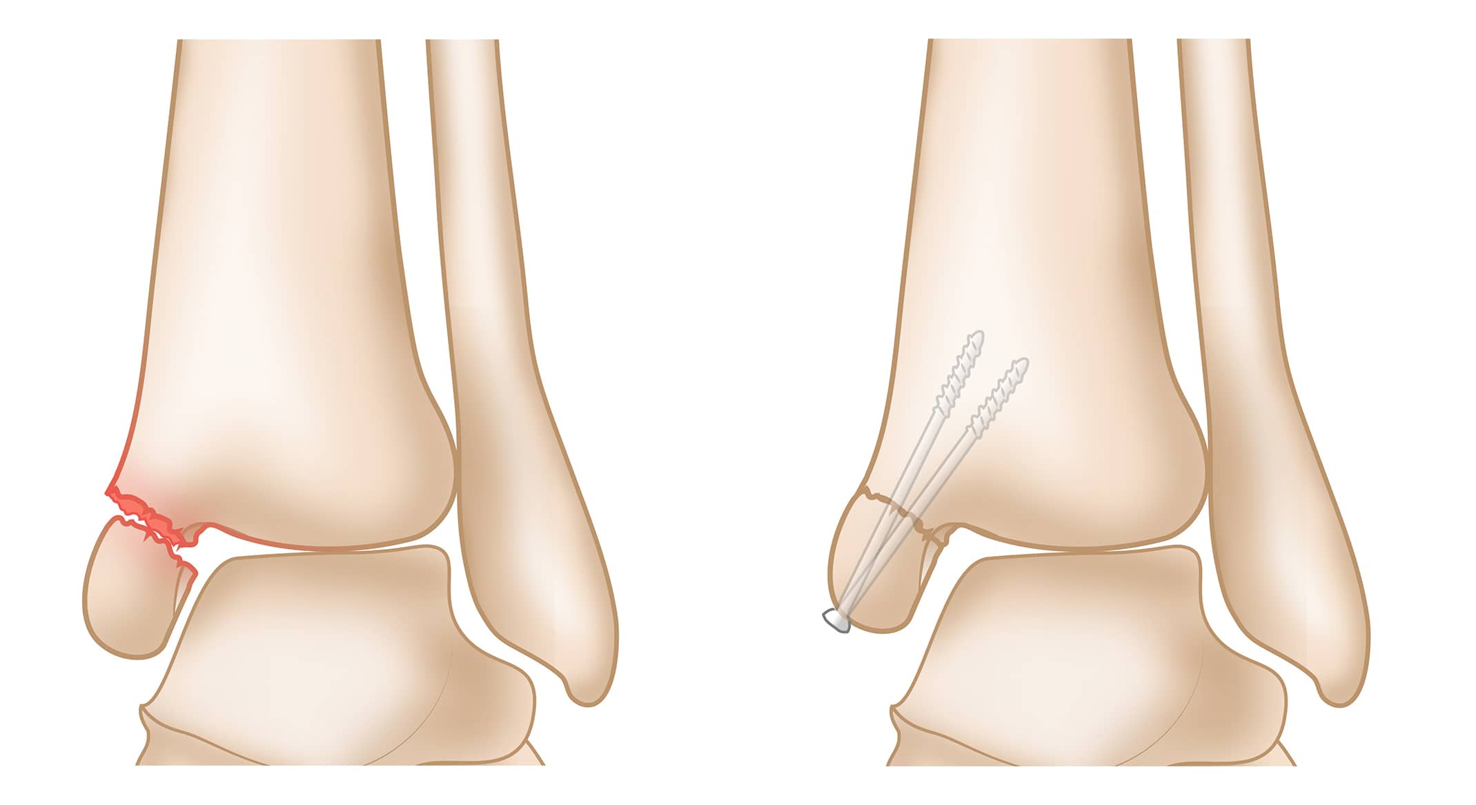Displaced Medial Malleolus Fracture and Repair