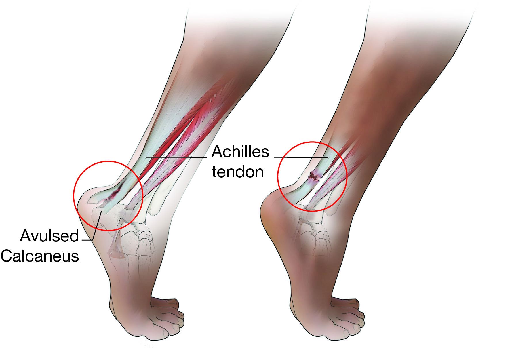 Illustration Showing Types of Complete Achilles Tendon Tears