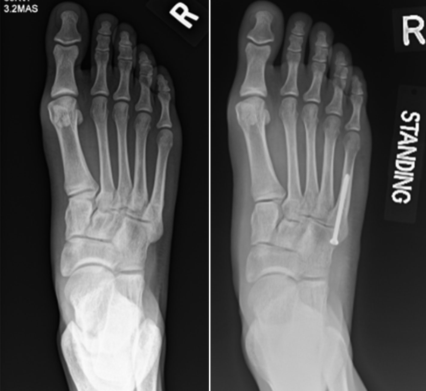 Jones fracture