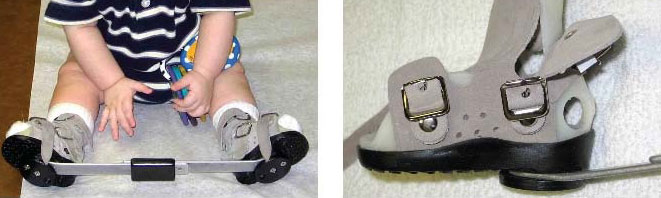 Mitchell-Ponseti Foot Abduction Brace
