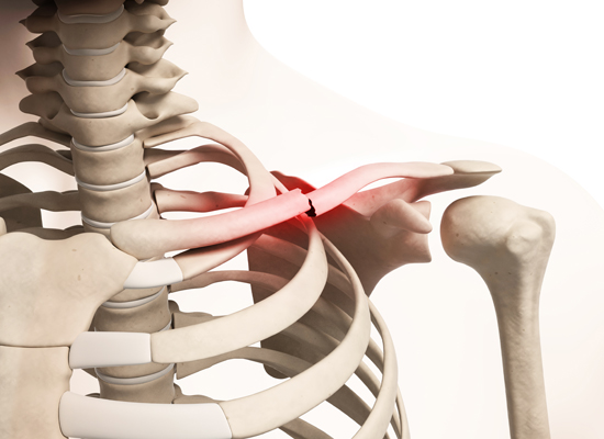 Scapula (Shoulder Blade) Fractures - OrthoInfo - AAOS