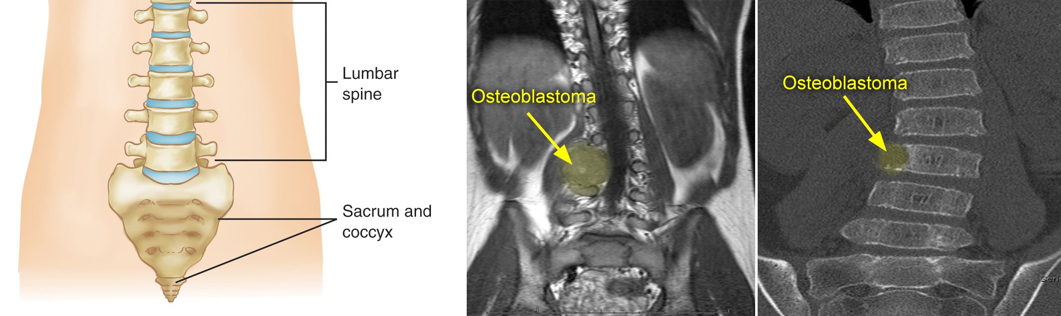 osteoblastoma that caused spinal curve
