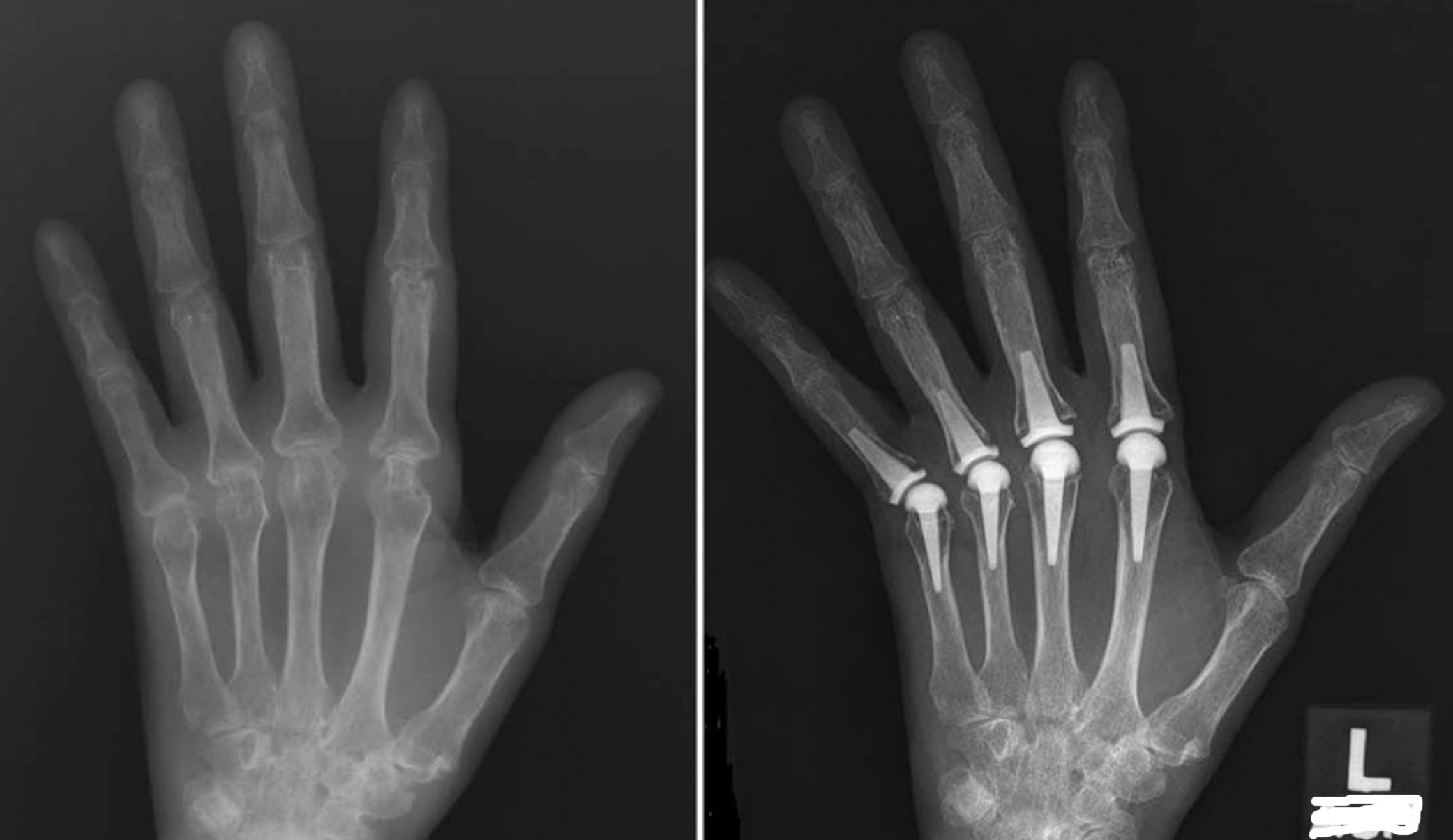 X-ray Showing Finger Arthritis and Finger Joint Replacement