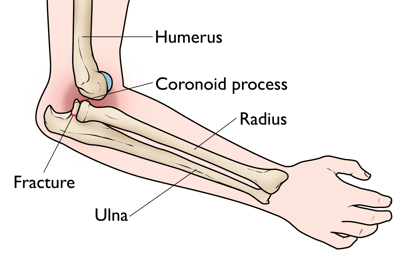 elbow fracture and dislocation