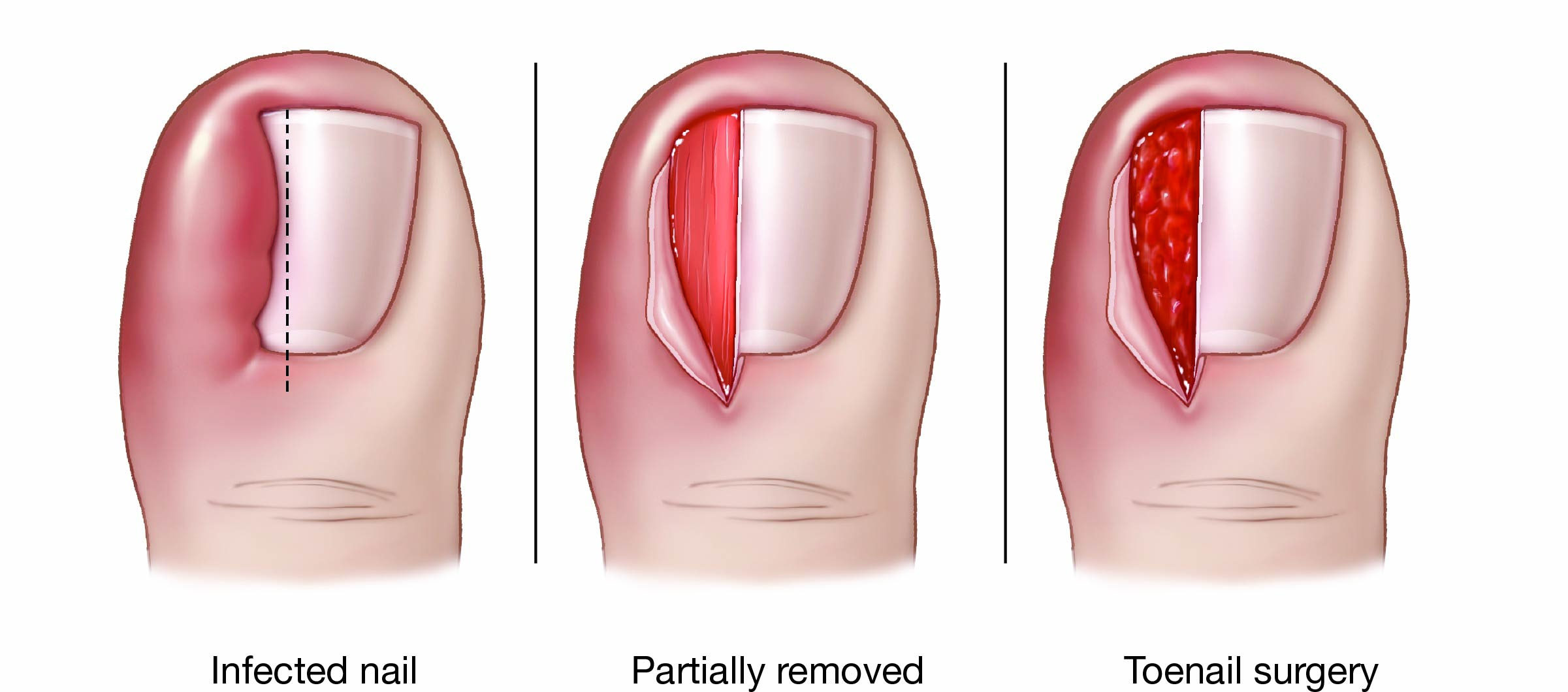 Treatment of ingrown toenail