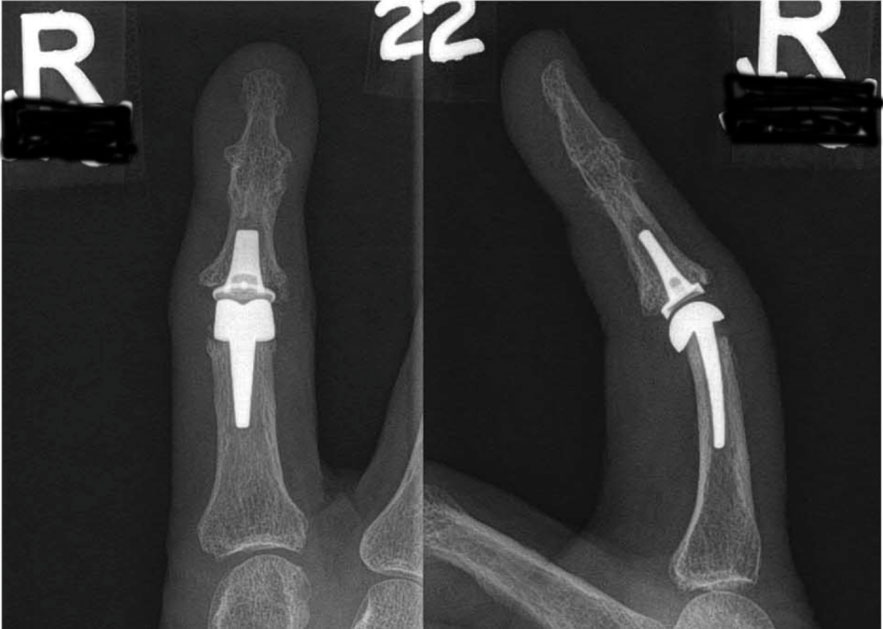 Post-operative X-rays of patient with severe arthritis of the index finger PIP joint