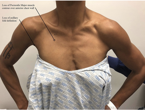 Clinical Photo Showing a Woman With a Pectoralis Tendon Tear