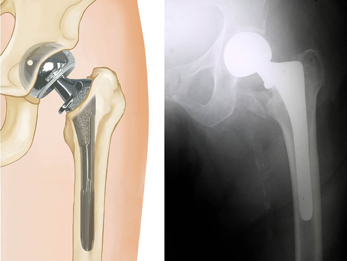 partial hip replacement