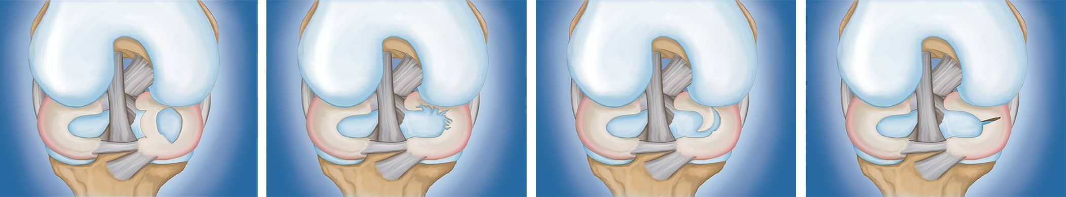 Types of Meniscus Tears