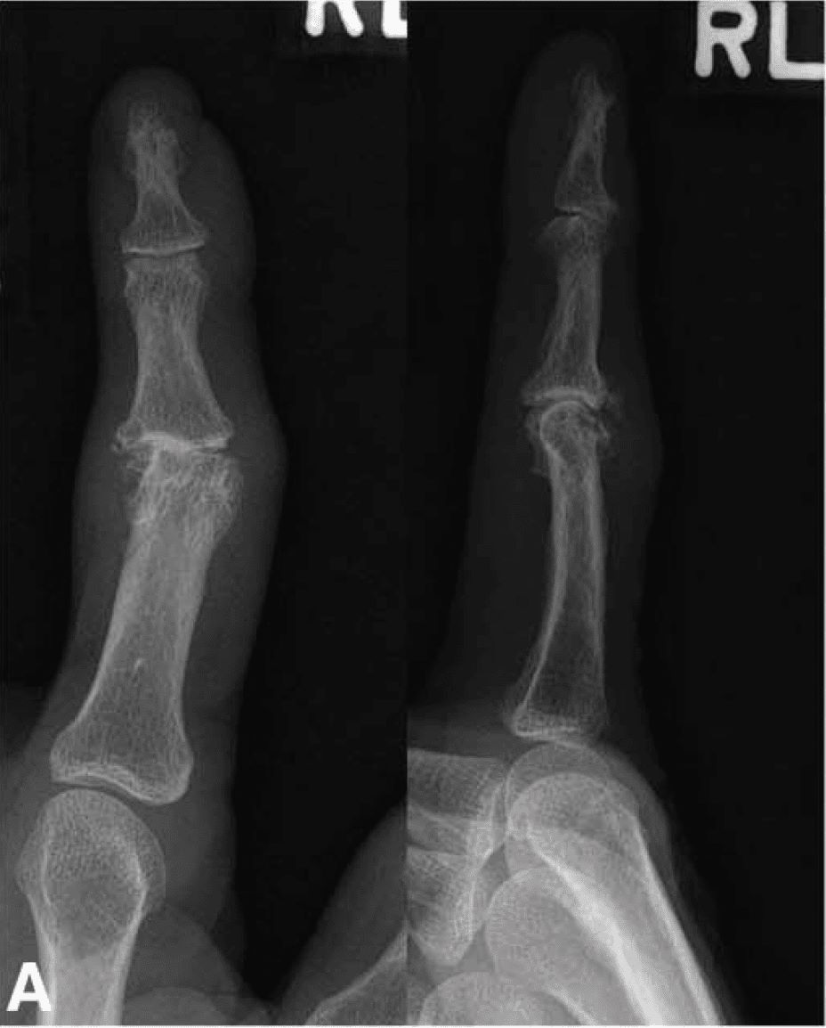 X-rays Showing Finger With Arthritis
