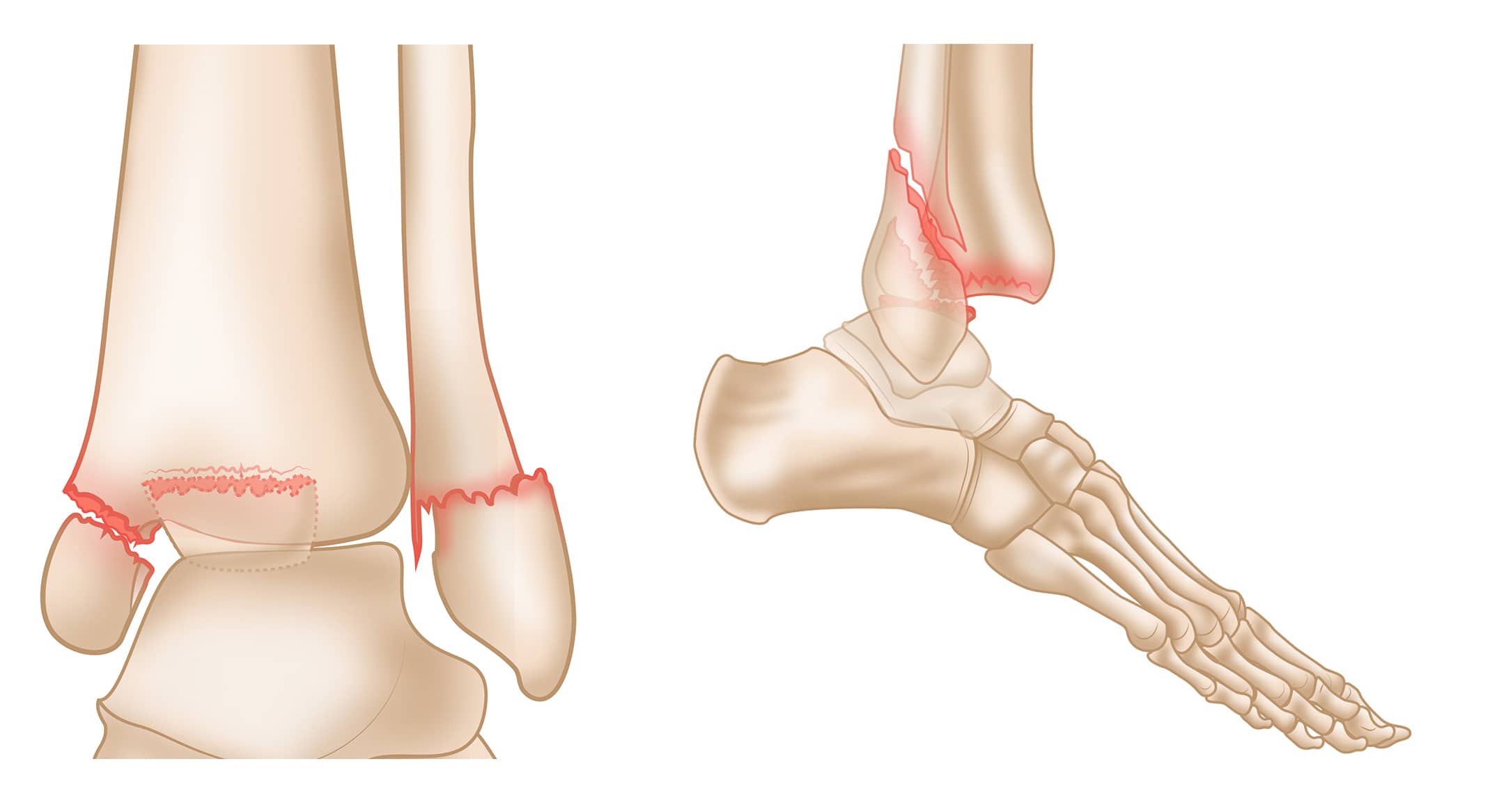 Trimalleolar Fracture and Repair