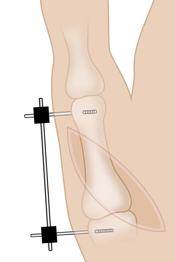 Internal fixation of thumb fracture